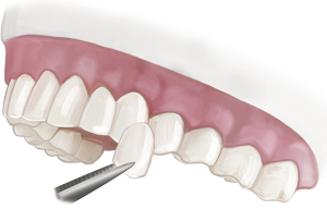dental veneers aurora
