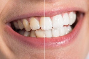 teeth whitening aurora